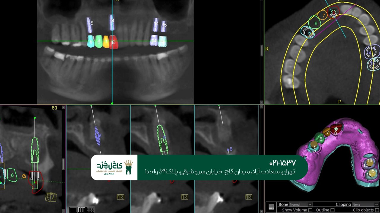 ایمپلنت دیجیتال تهران ایمپلنت دیجیتال تهران