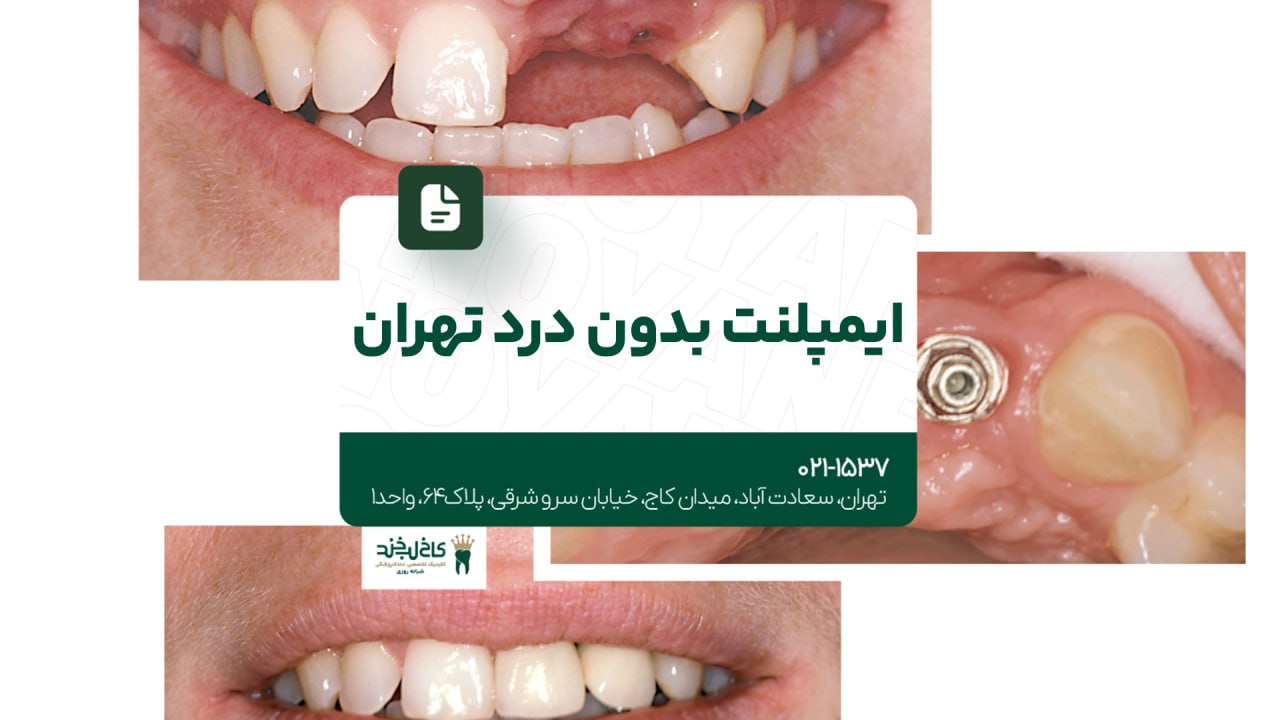 ایمپلنت بدون درد تهران ایمپلنت بدون درد تهران