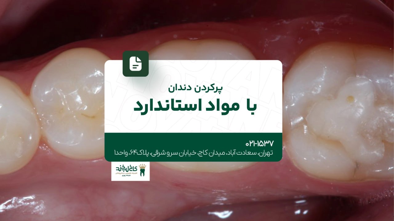 پر کردن دندان با مواد استاندارد پر کردن دندان با مواد استاندارد