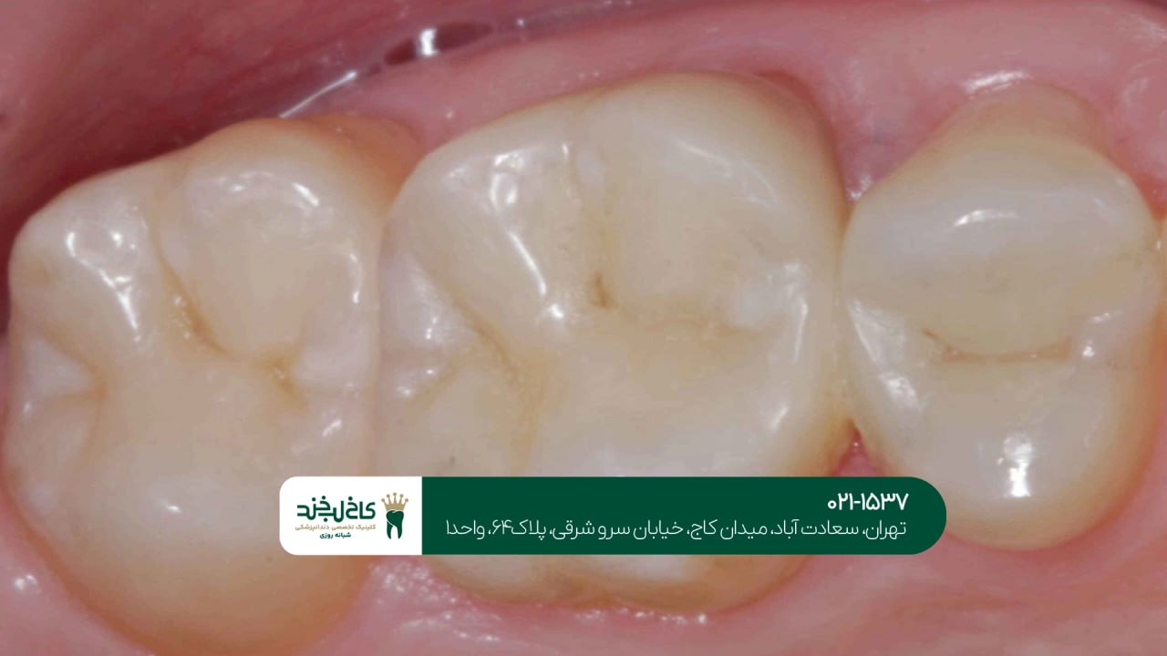 پرکردندان دندان در کلینیک پرکردندان دندان در کلینیک