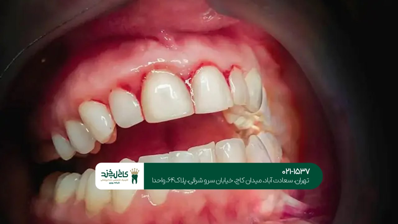 مزایای پیشگیری از بیماری های دندان و لثه مزایای پیشگیری از بیماری های دندان و لثه