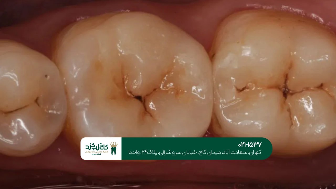 مزایای ترمیم و بازسازی دندان مزایای ترمیم و بازسازی دندان