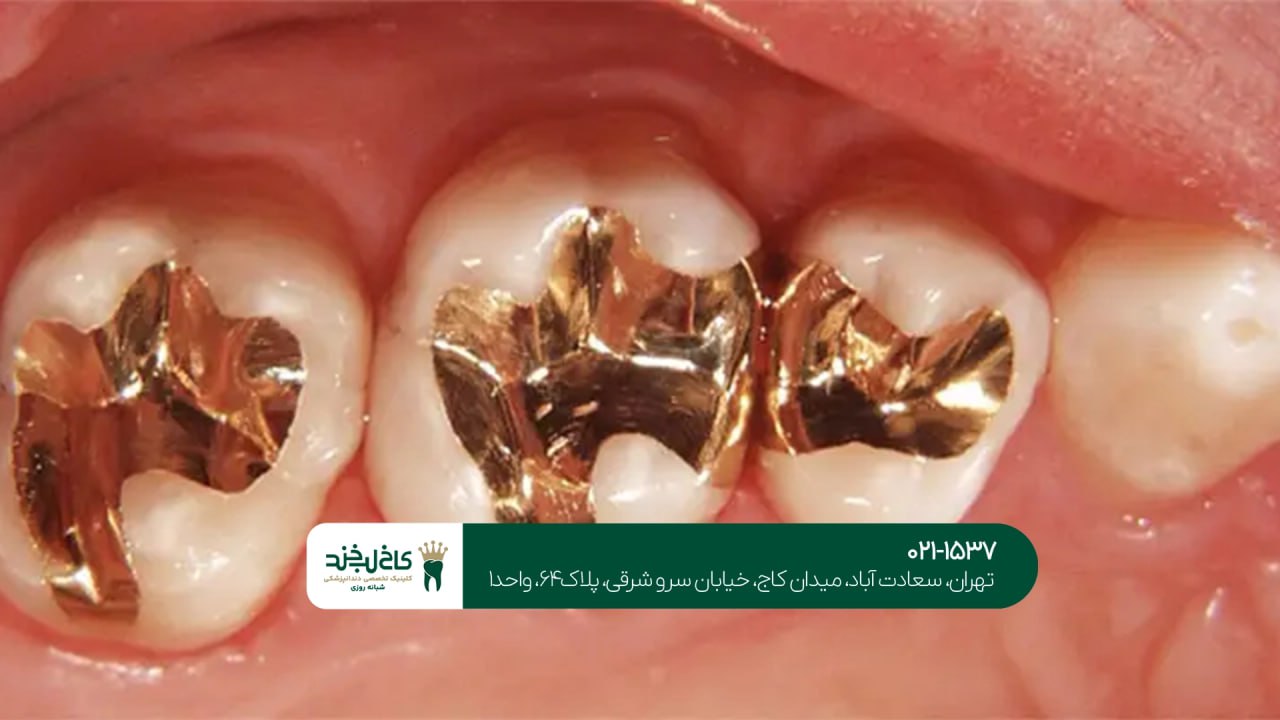 روش های ترمیم و بازسازی دندان روش های ترمیم و بازسازی دندان