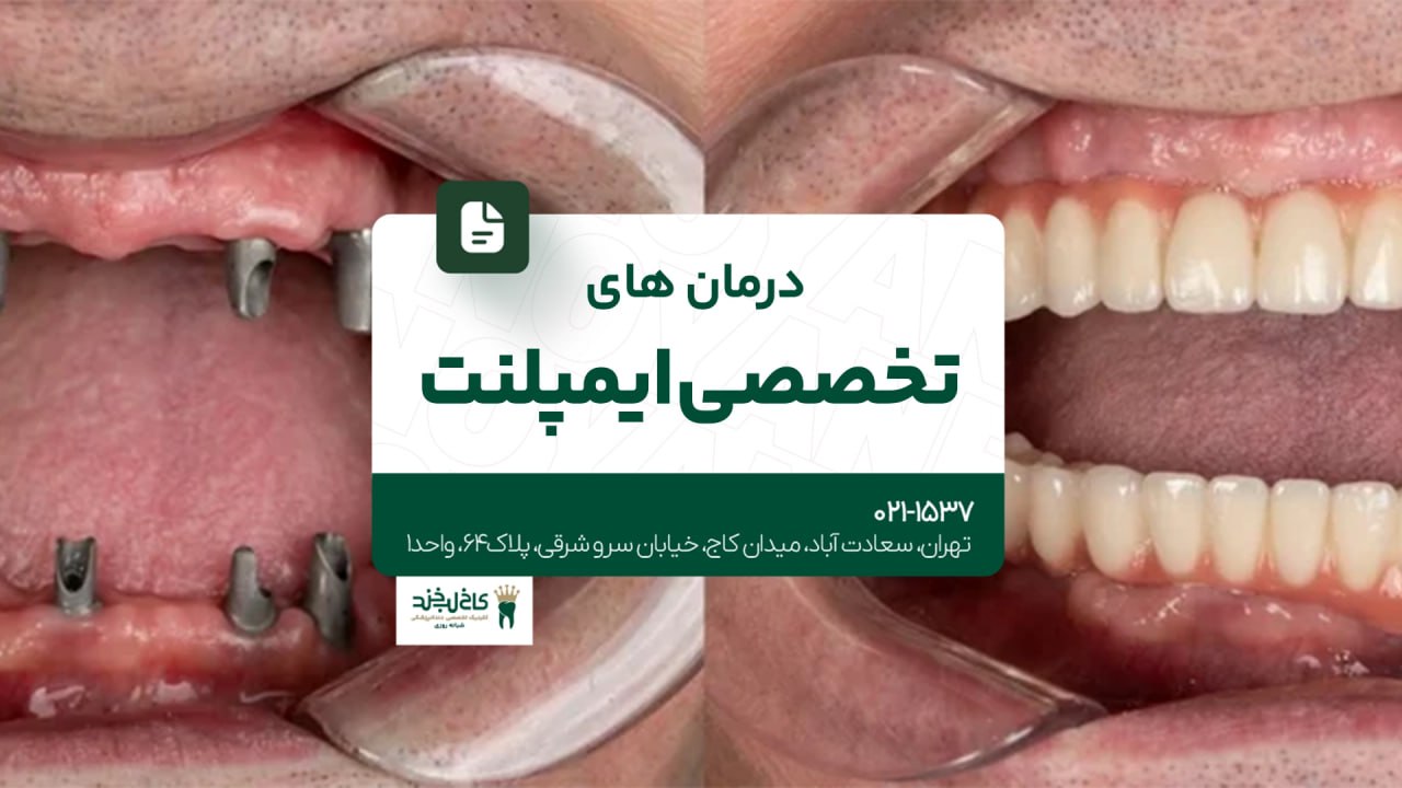 درمان های تخصصی ایمپلنت درمان های تخصصی ایمپلنت