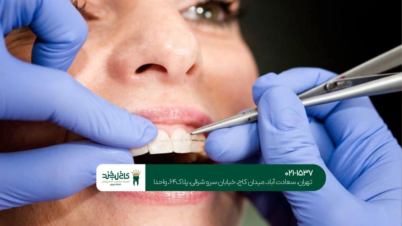 مدت زمان ارتودنسی دندان مدت زمان ارتودنسی دندان