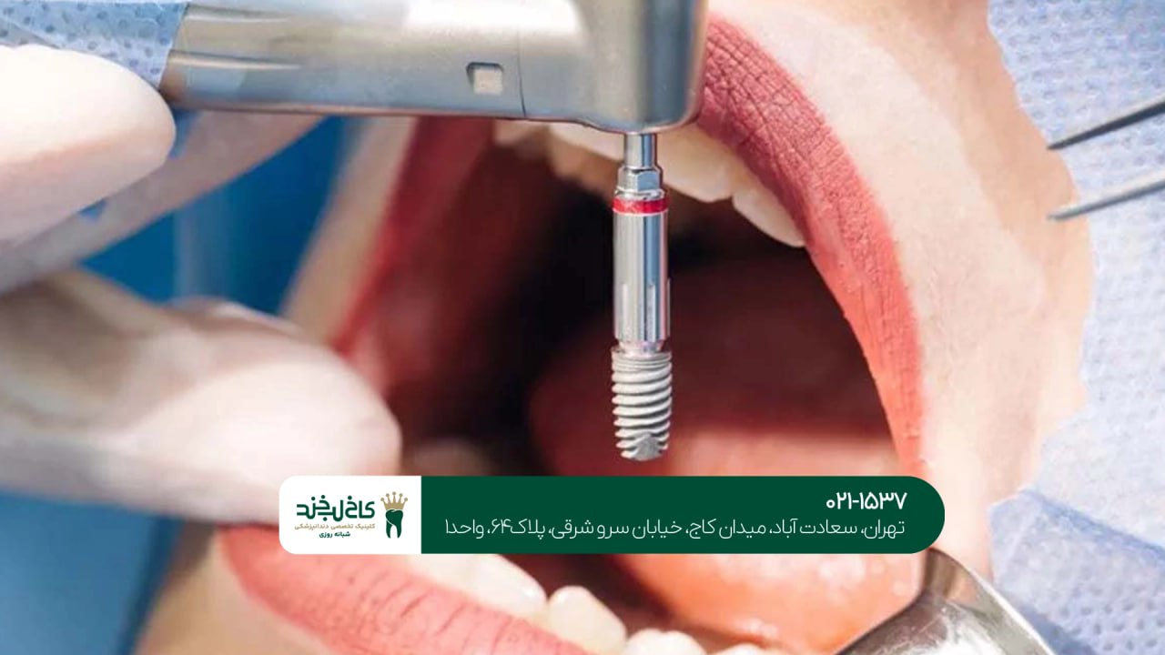 ایمپلنت دندان ایمپلنت دندان