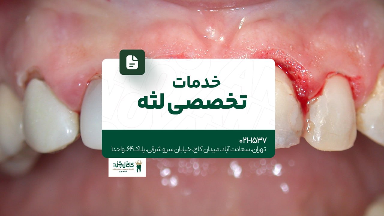 خدمات تخصصی لثه خدمات تخصصی لثه