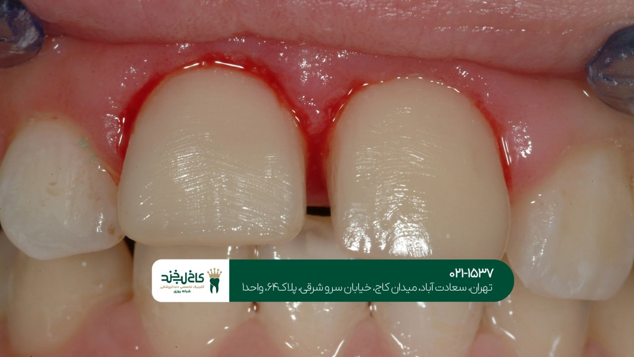 التهاب لثه التهاب لثه