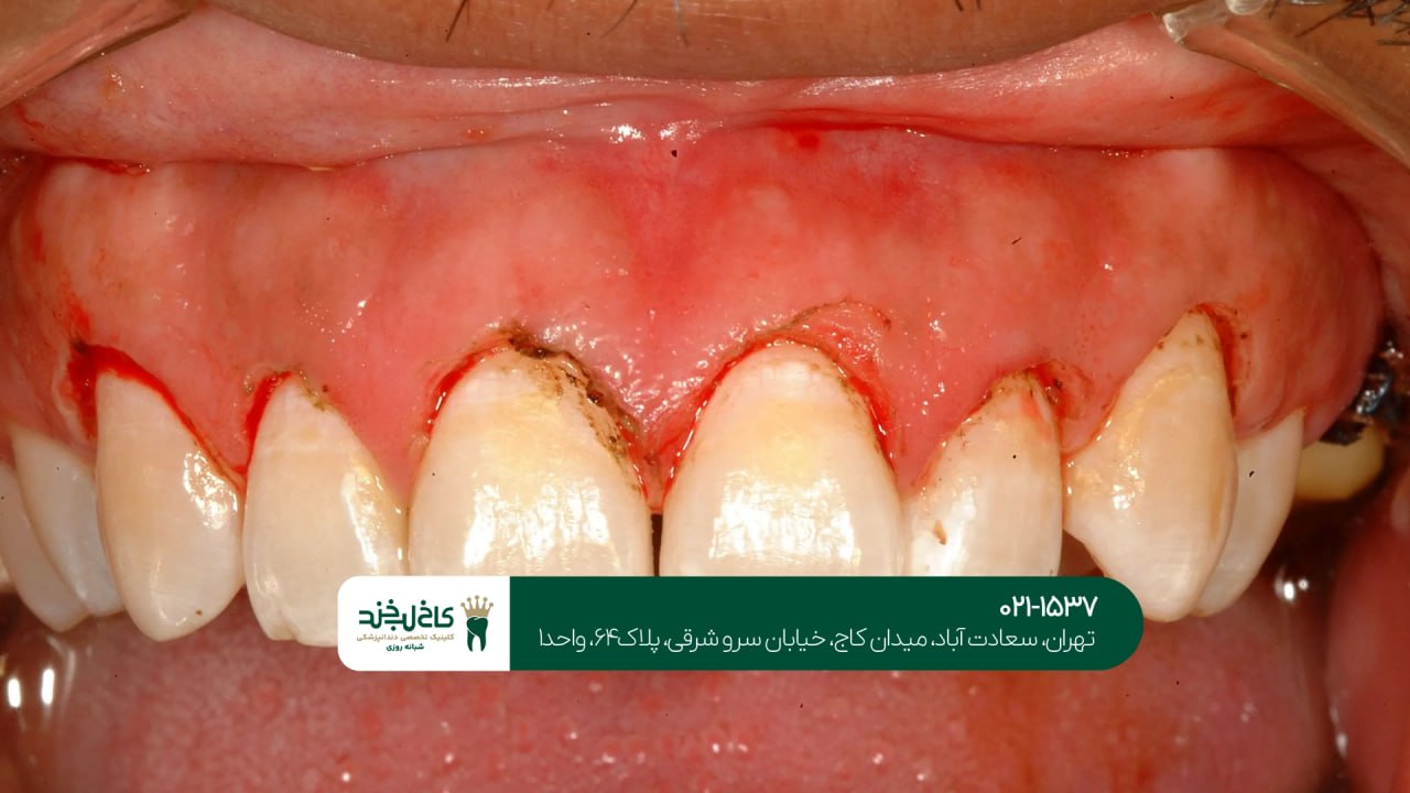 جراحی لثه جراحی لثه