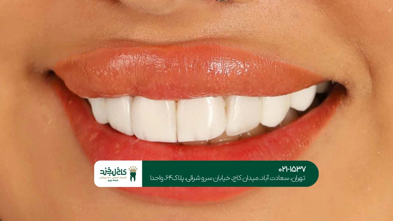 طراحی لبخند با کامپوزیت