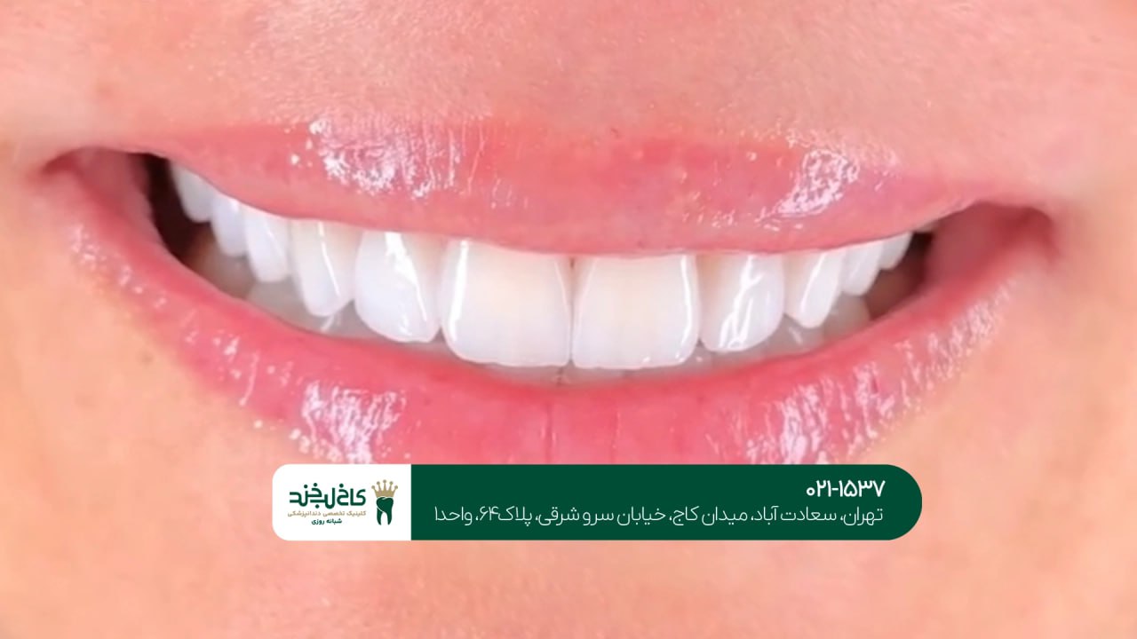 دندانپزشکی زیبایی برای طرح لبخند