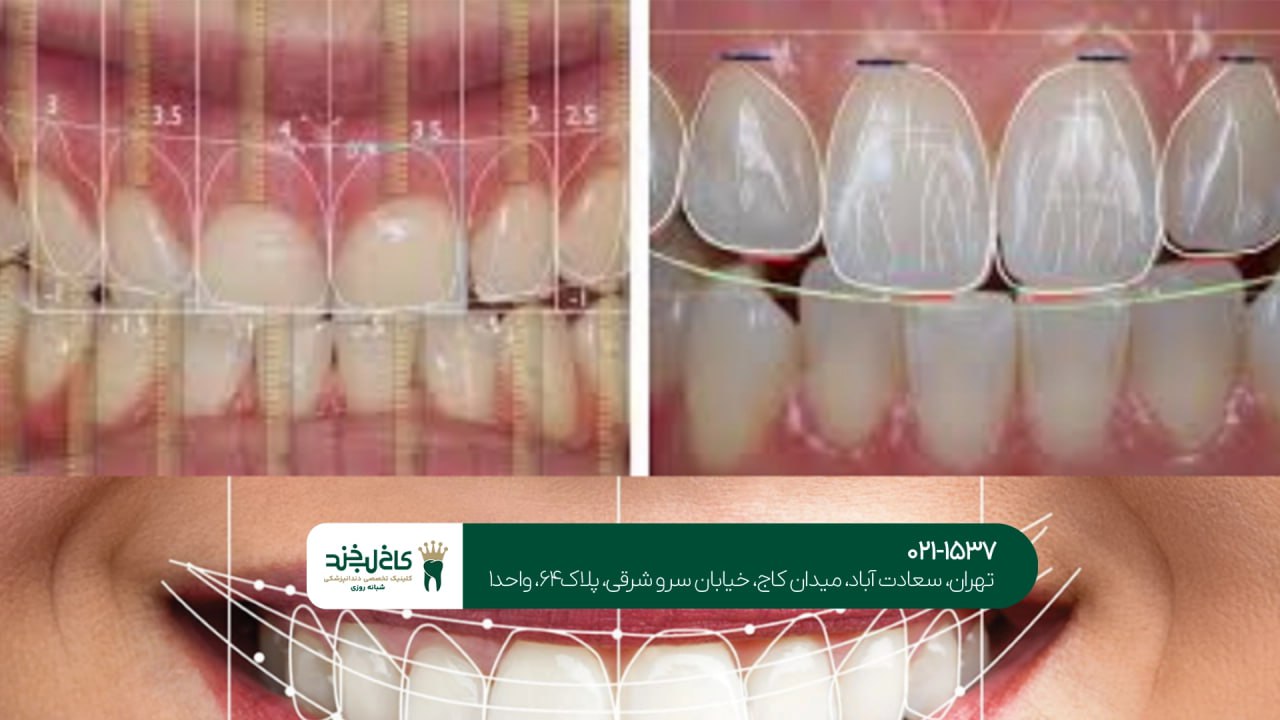 طراحی دیجیتال لبخند به صورت تخصصی