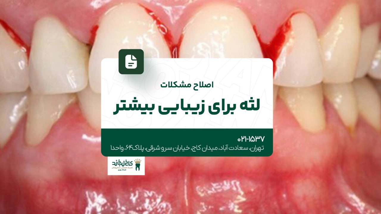 اصلاح مشکلات لثه برای زیبایی بیشتر