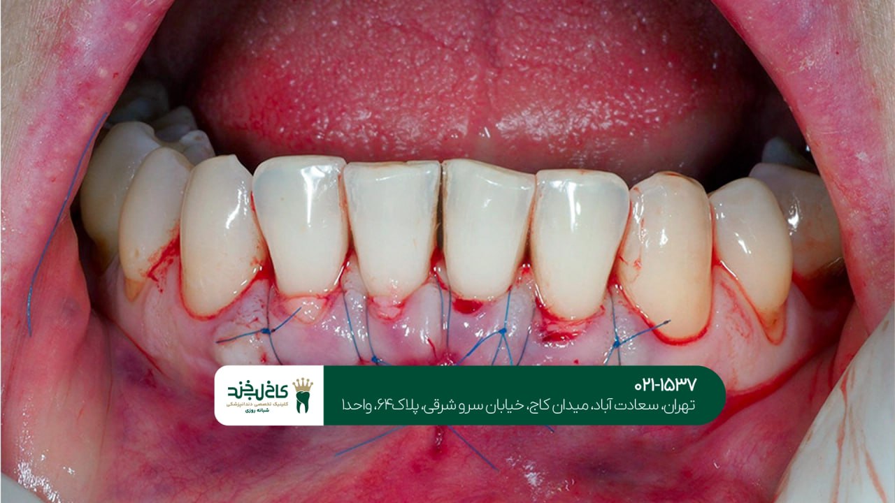 اصلاح مشکلات لثه برای زیبایی بیشتر