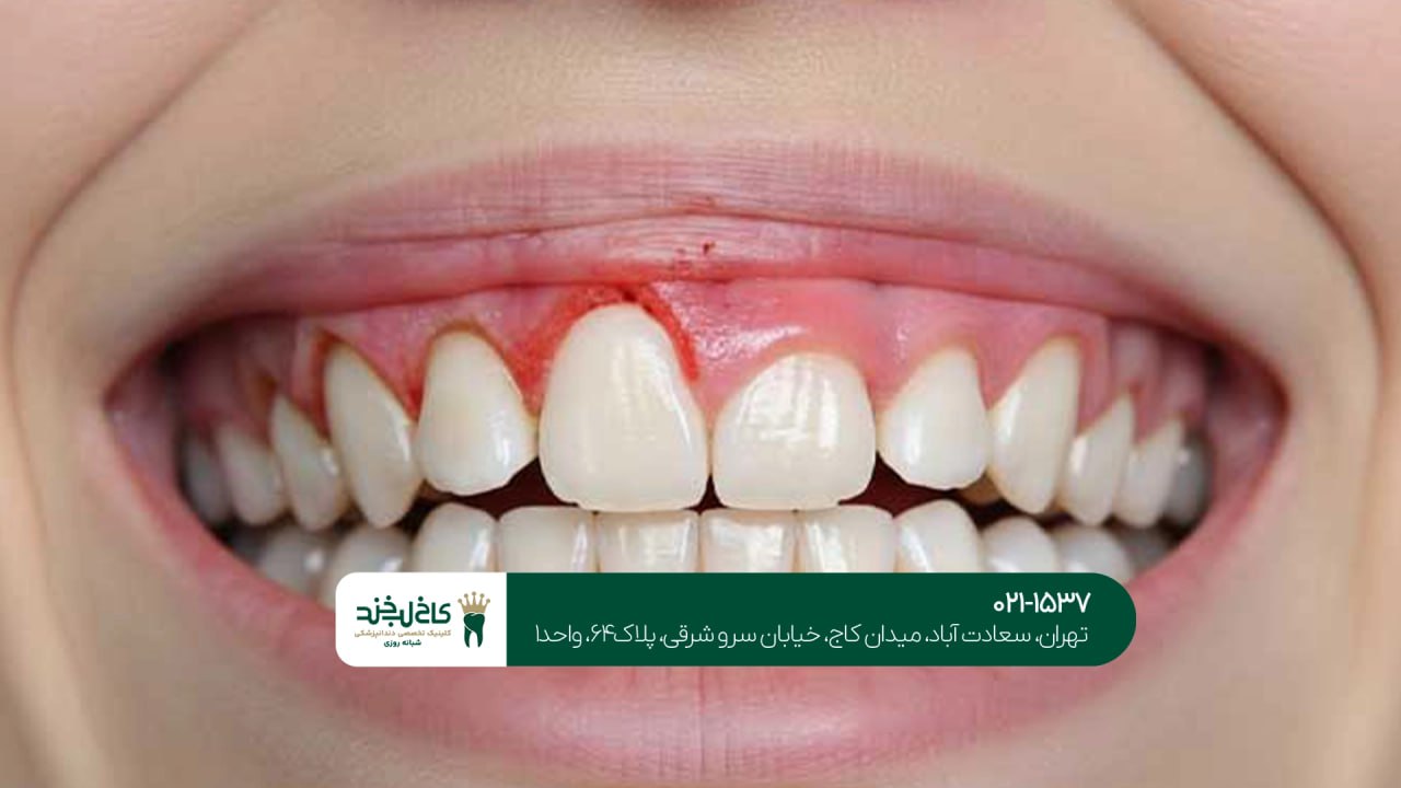 اصلاح مشکلات لثه برای زیبایی بیشتر