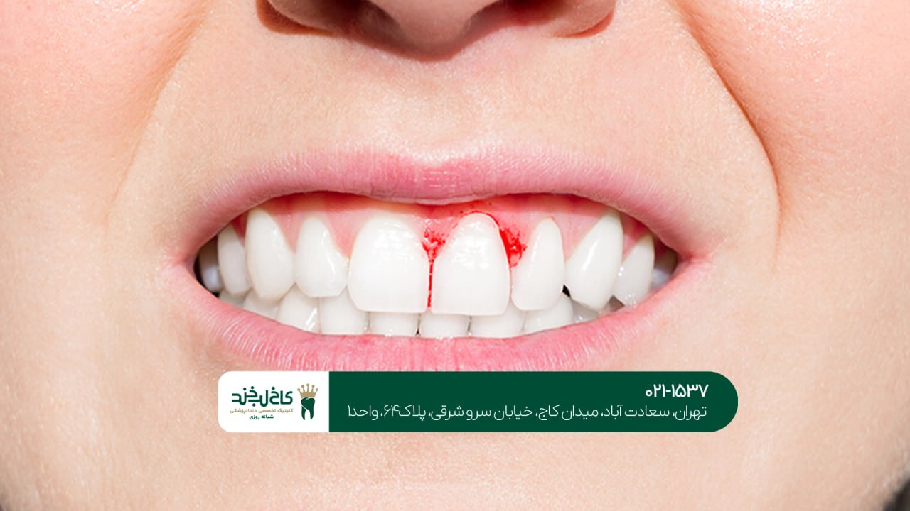اصلاح مشکلات لثه برای زیبایی بیشتر