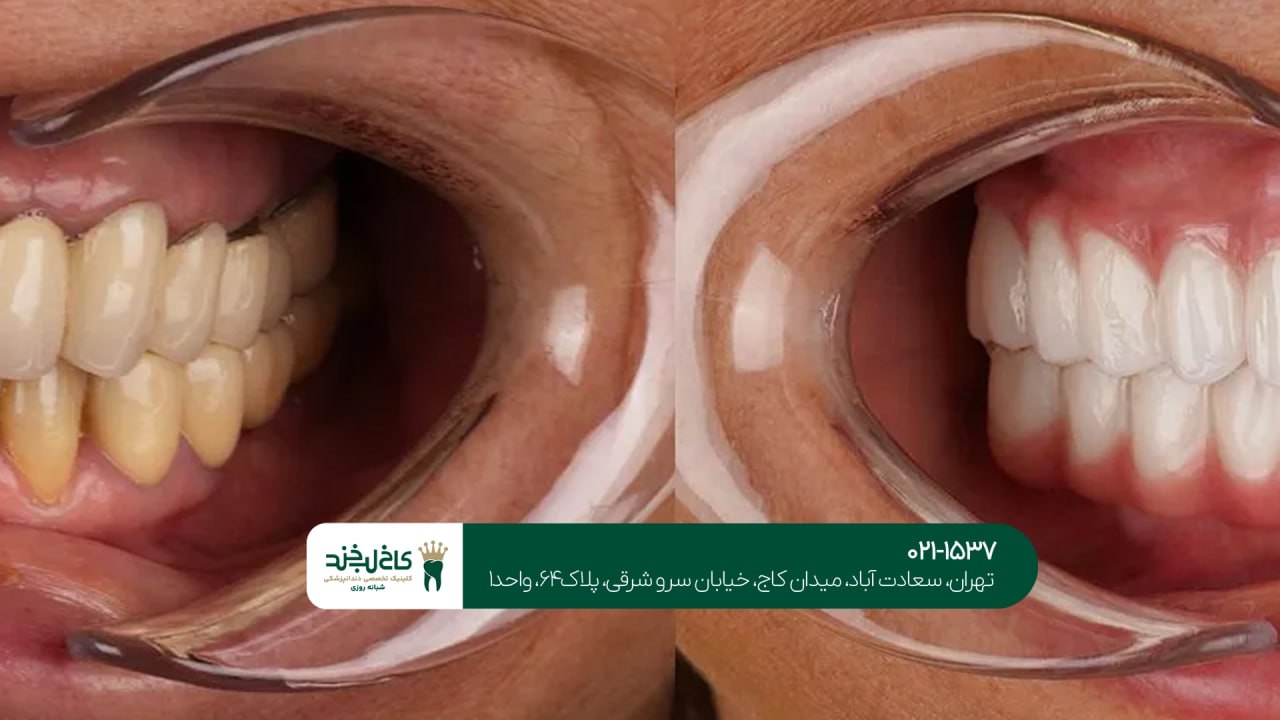 اصلاح ظاهر دندانهای زرد