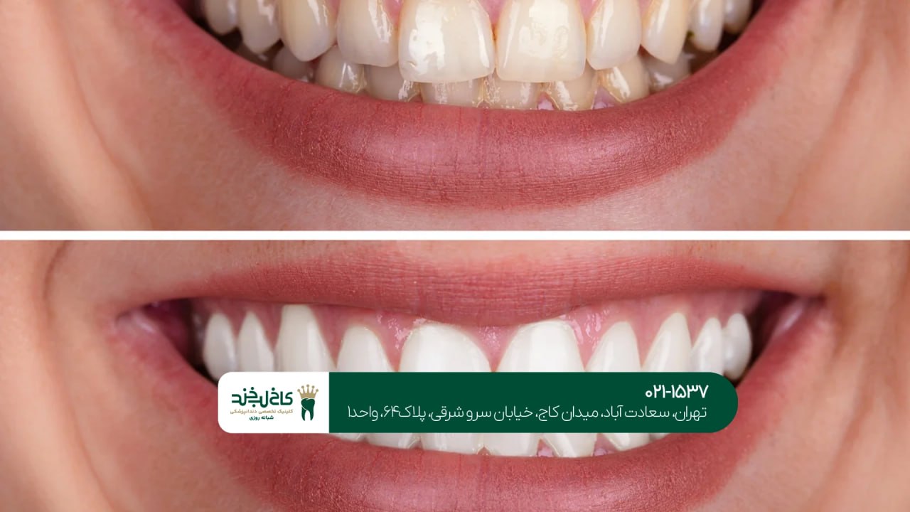 اصلاح ظاهر دندانهای زرد
