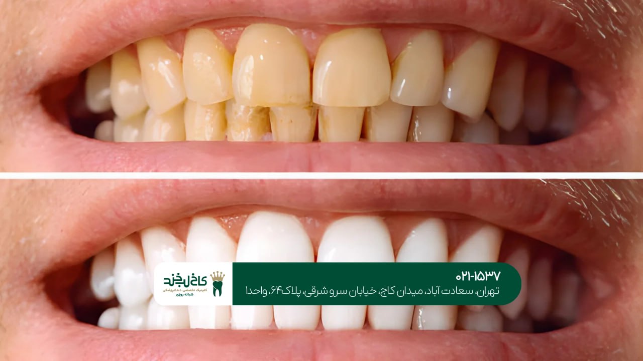 اصلاح ظاهر دندانهای زرد