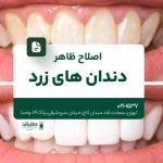 اصلاح ظاهر دندانهای زرد