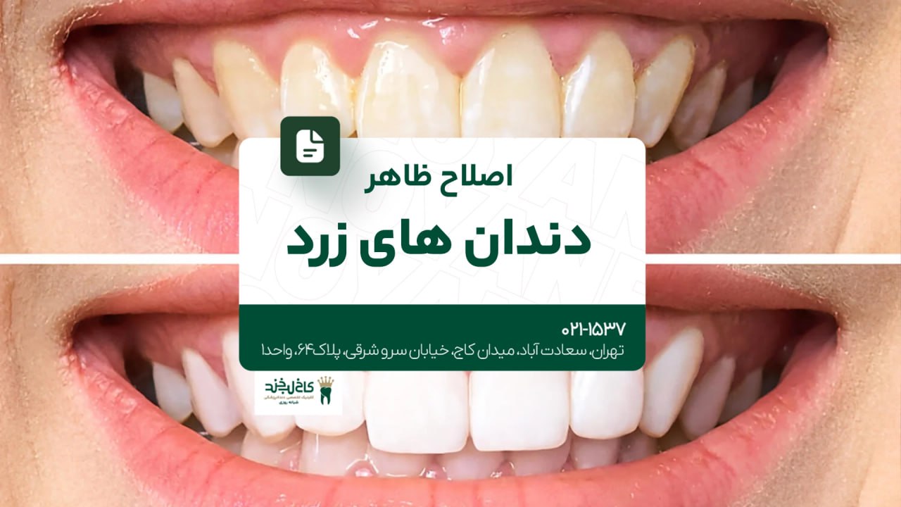 اصلاح ظاهر دندانهای زرد