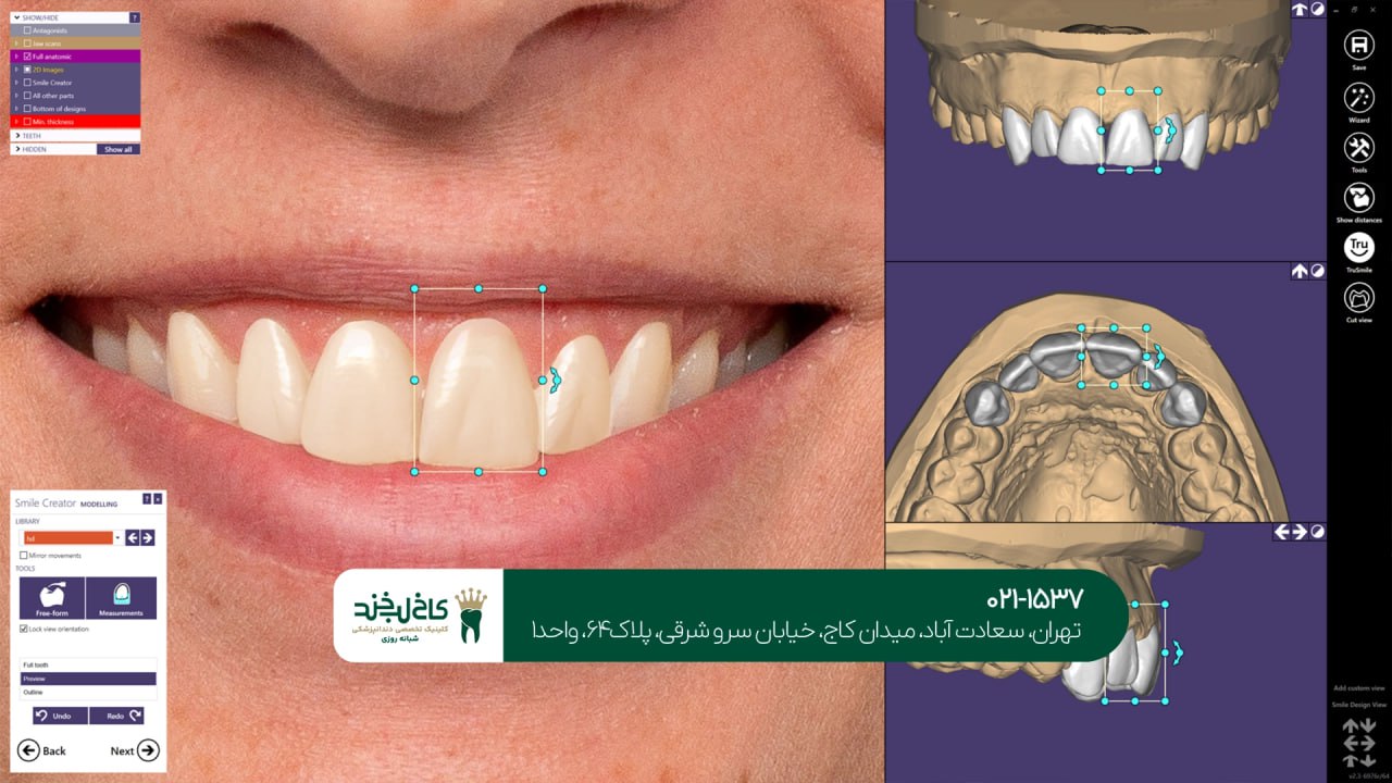 طراحی دیجیتال لبخند با نرمافزار پیشرفته