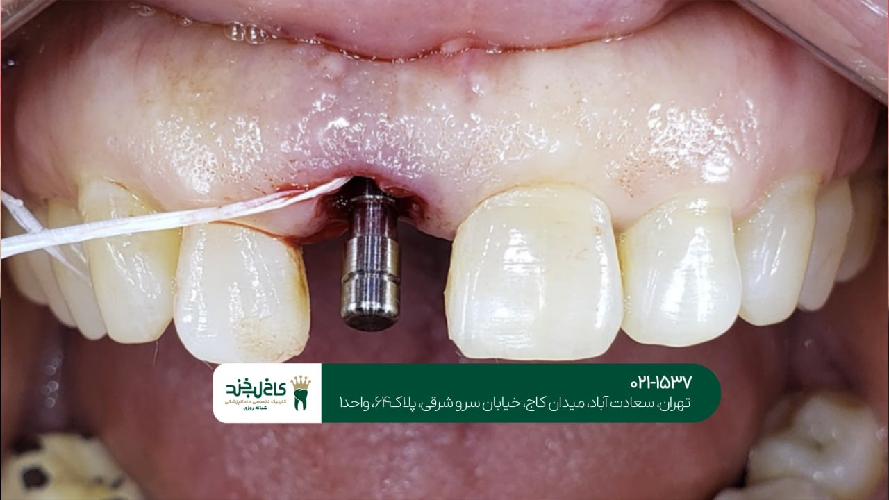 استفاده از تکنولوژیهای جدید در ایمپلنت