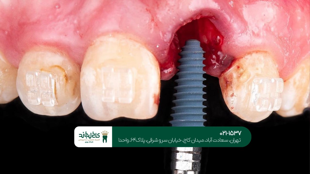 استفاده از تکنولوژیهای جدید در ایمپلنت