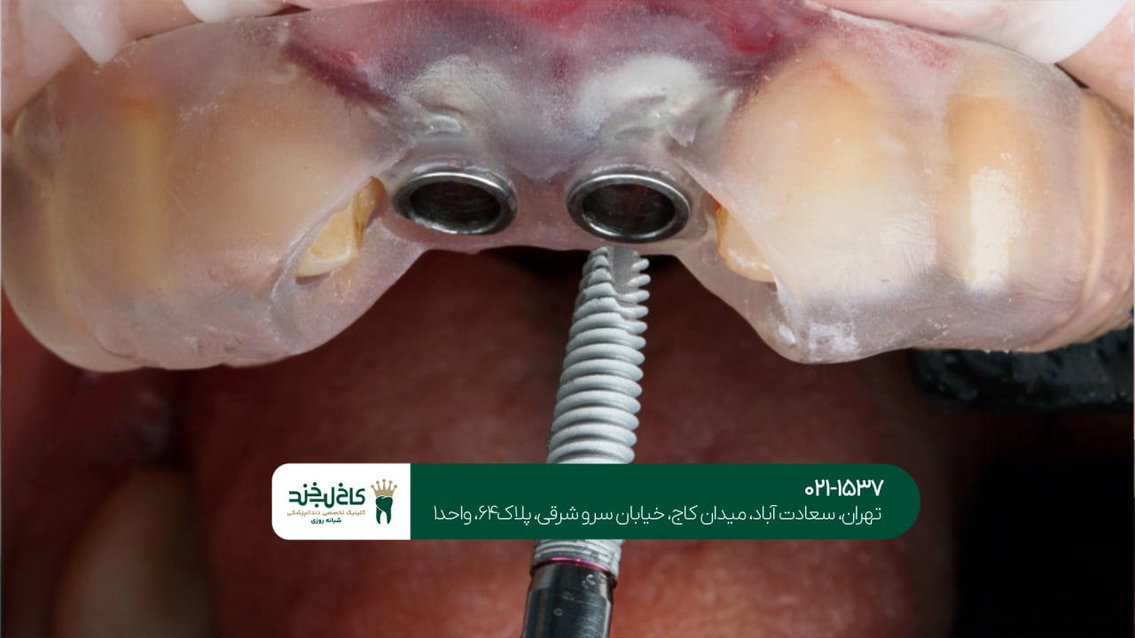 تجهیزات پیشرفته برای انجام ایمپلنت