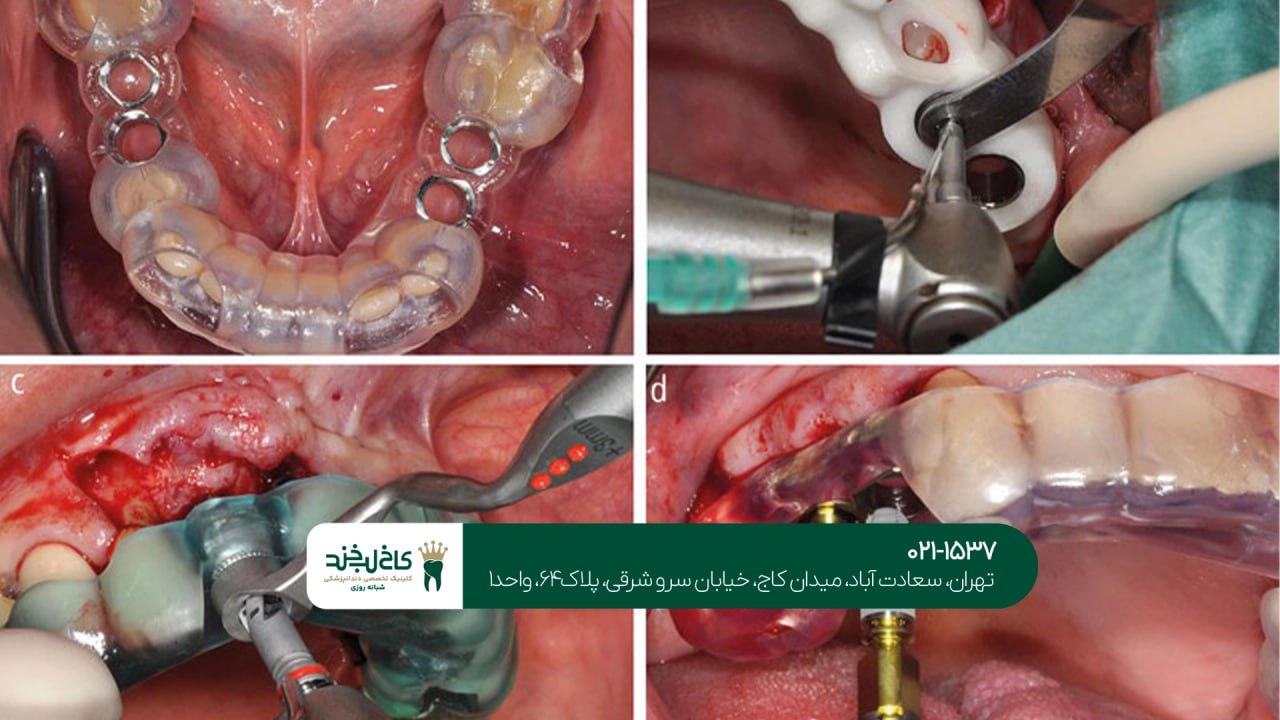 تجهیزات پیشرفته برای انجام ایمپلنت