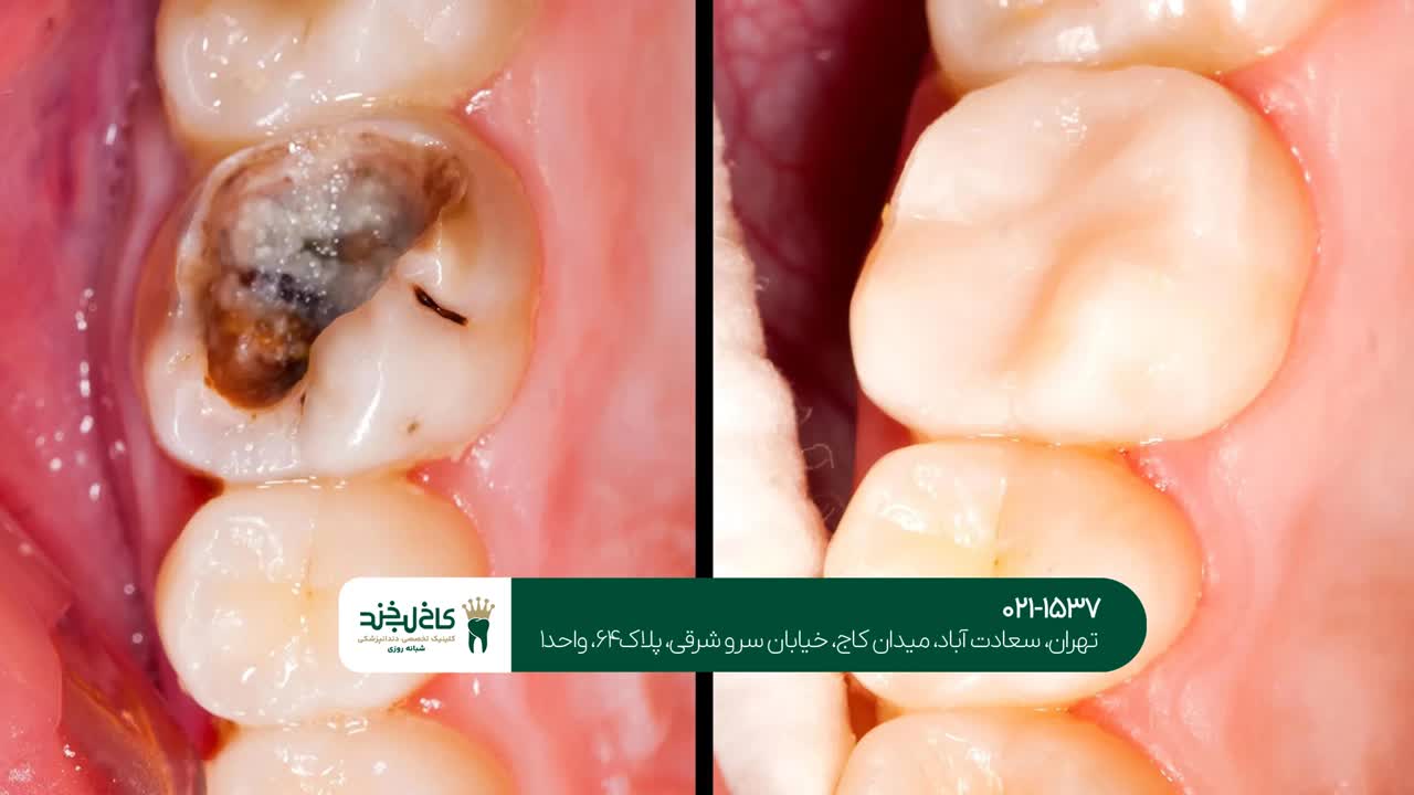 درمان دندانهای خراب