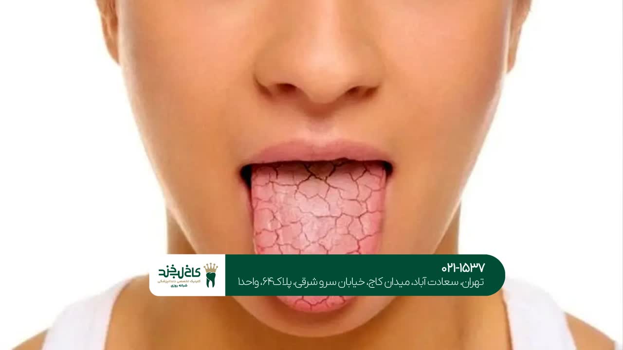 درمان دهان خشک