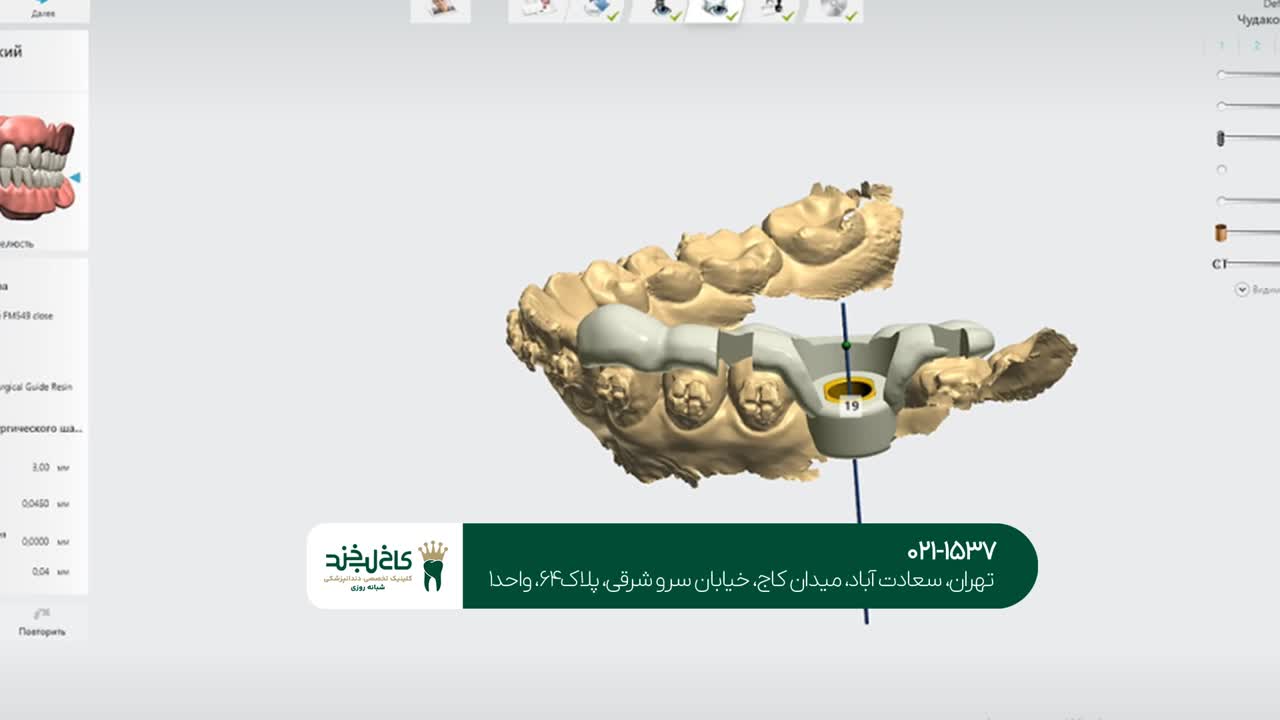 ایمپلنت دندان به صورت دیجیتال