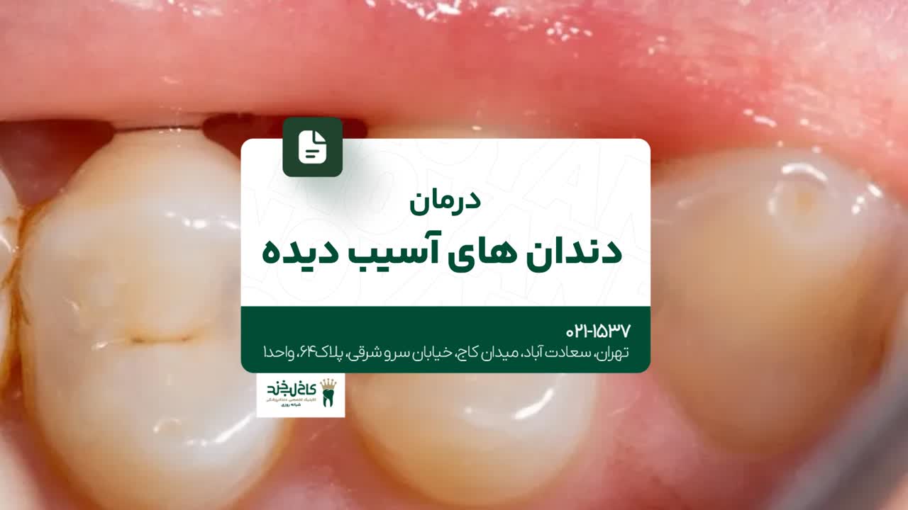 درمان دندانهای آسیب دیده
