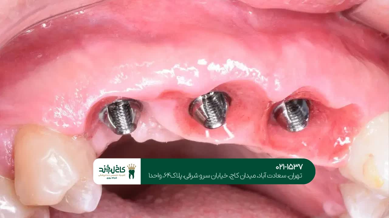 بهترین روشهای ایمپلنت دندان