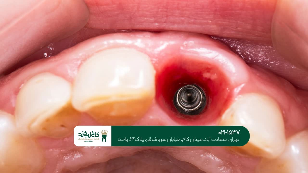 ایمپلنت دندان یک روزه