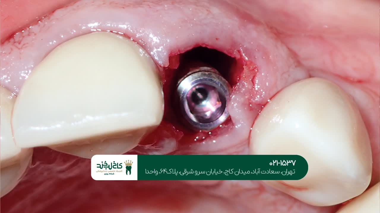 ایمپلنت دندان با سرعت بالا