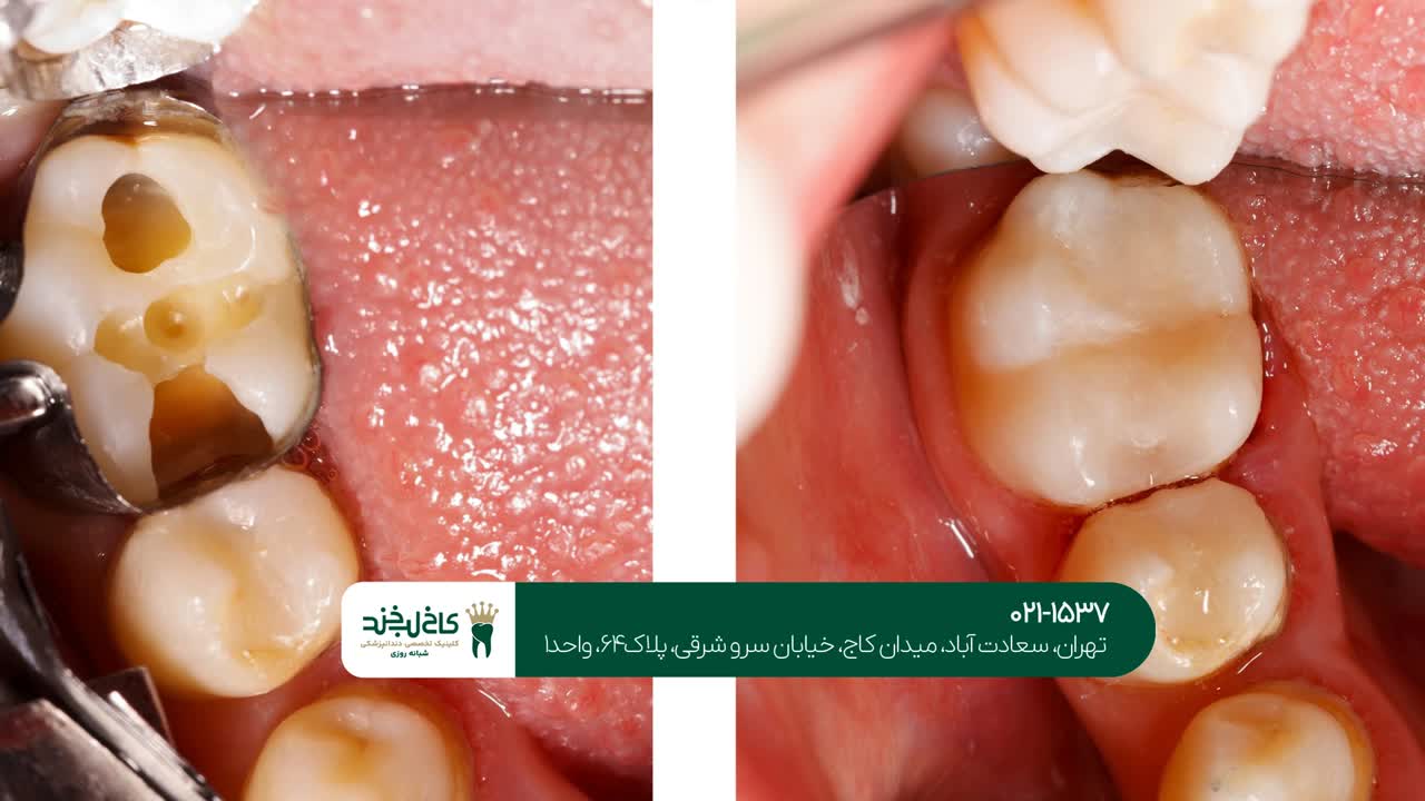 درمان دندان های پوسیده شدید