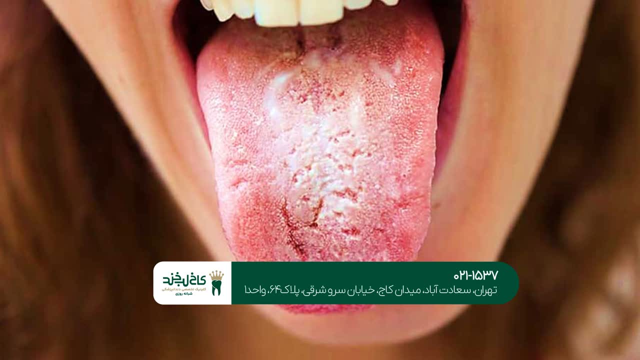 درمان بیماریهای دهان