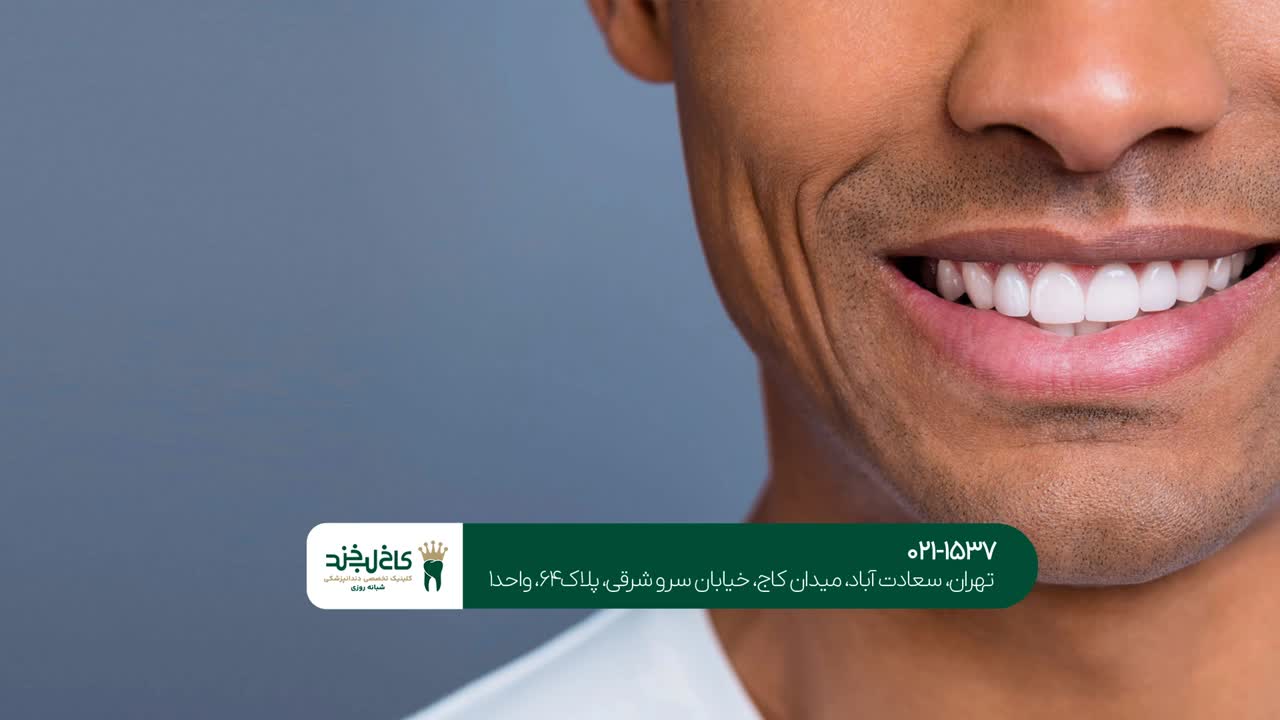 کامپوزیت دندان کامپوزیت دندان