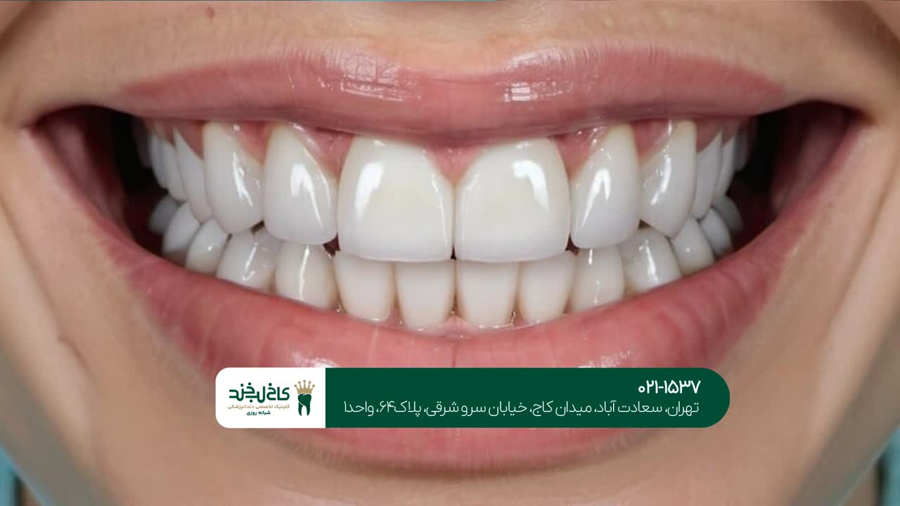 طول عمر کامپوزیت دندان طول عمر کامپوزیت دندان