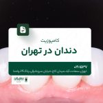 کامپوزیت دندان در تهران
