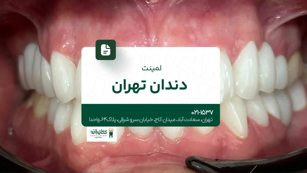 لمینت دندان تهران لمینت دندان تهران