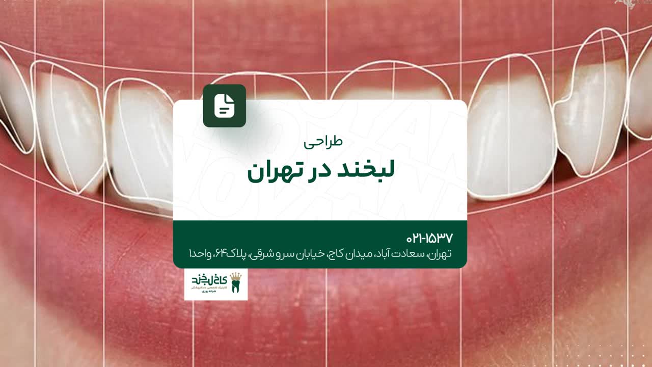 طراحی لبخند در تهران طراحی لبخند در تهران