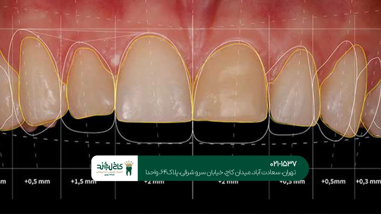 طراحی لبخند طراحی لبخند