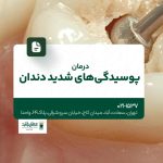 درمان پوسیدگی های شدید دندان