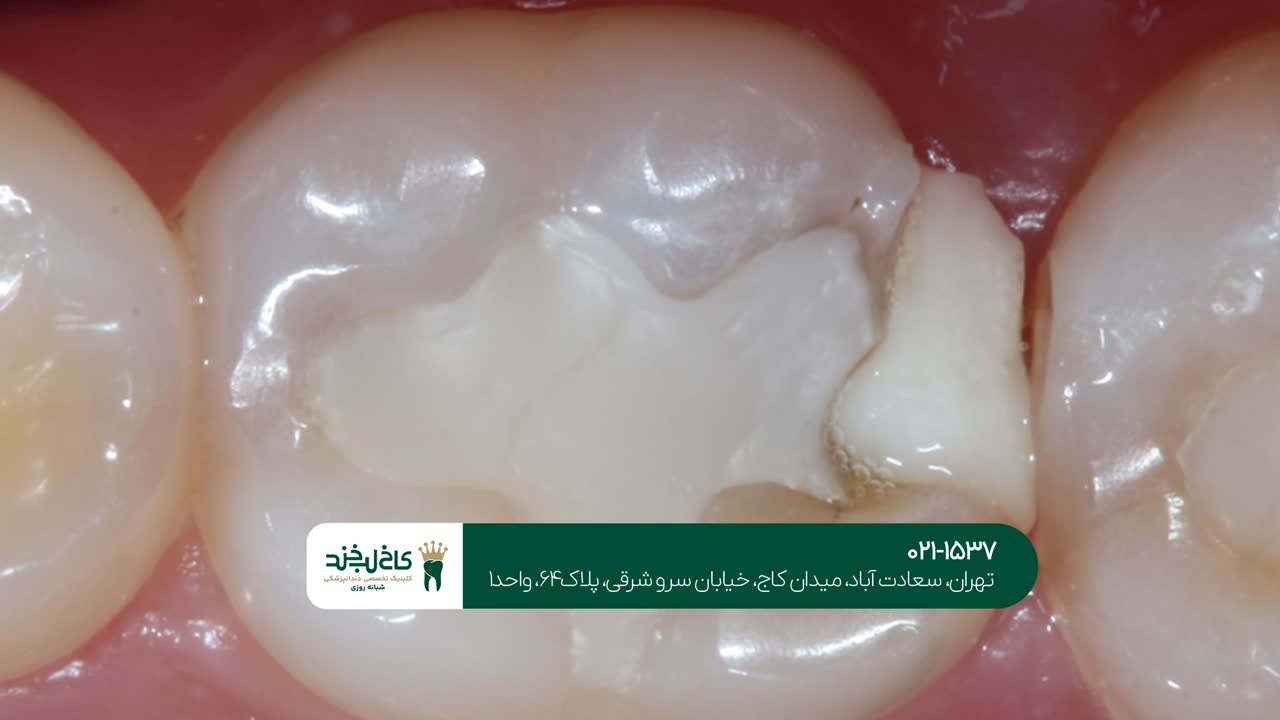 پوسیدگی های دندان پوسیدگی های دندان
