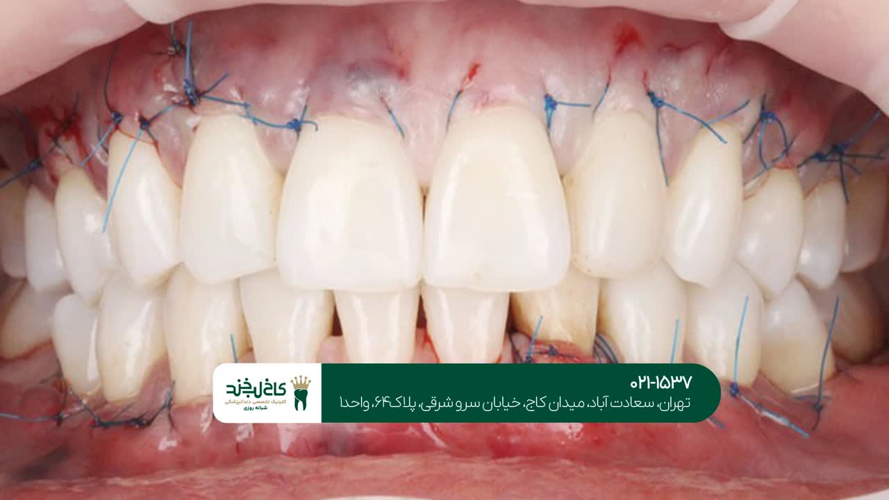 عوارض جراحی لثه عوارض جراحی لثه