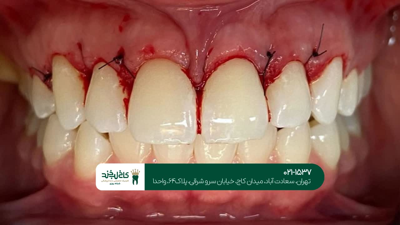 جراحی لثه جراحی لثه