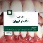 جراحی لثه در تهران